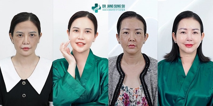 Jang Sung Su sử dụng công nghệ gì, đến từ nước nào? 7 Công nghệ hiện đại được ứng dụng trong nâng cơ